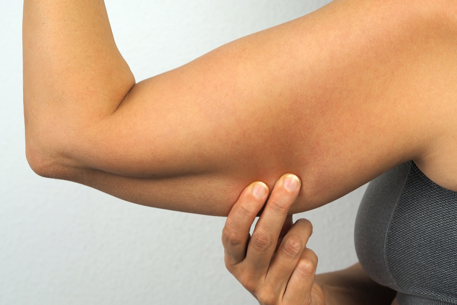 Lipödem am Arm